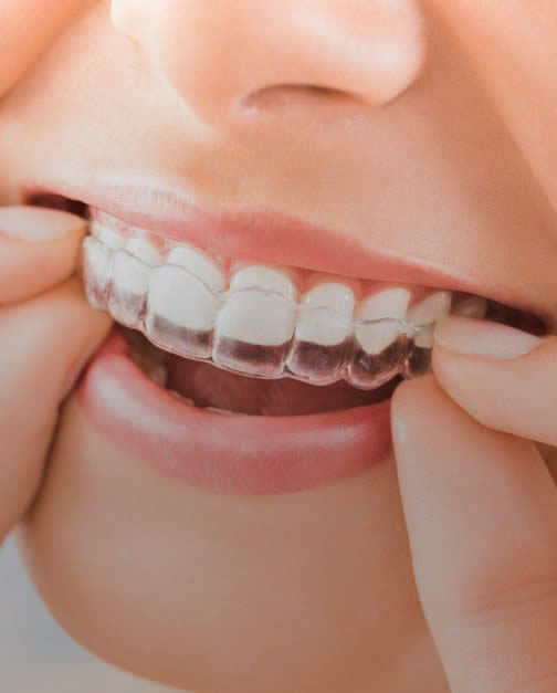 Close of invisalign clear bracket on teeth