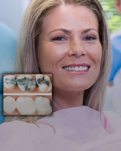 Close of before and after of metal and white fillings