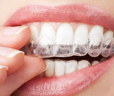 Invisalign: Achieving Straight Teeth Without Braces