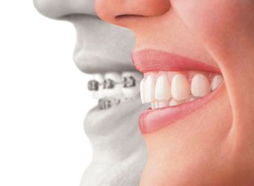 Choosing Invisalign