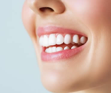 Instant Orthodontics (aka Porcelain Veneers)
