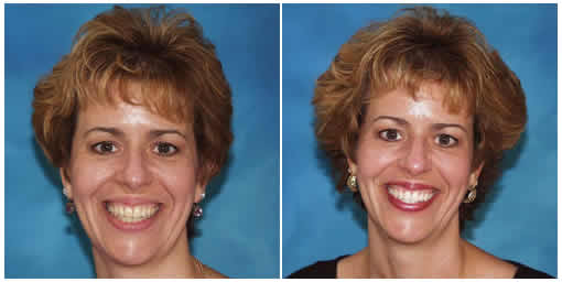 How Dentures Can Improve Your Smile