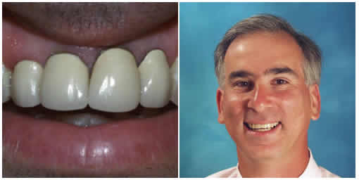 Invisalign: A Modern Way to Improve your Smile