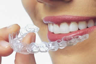 Reasons that Dental Veneers Are a Popular Choice