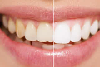 What to Do in a Dental Emergency