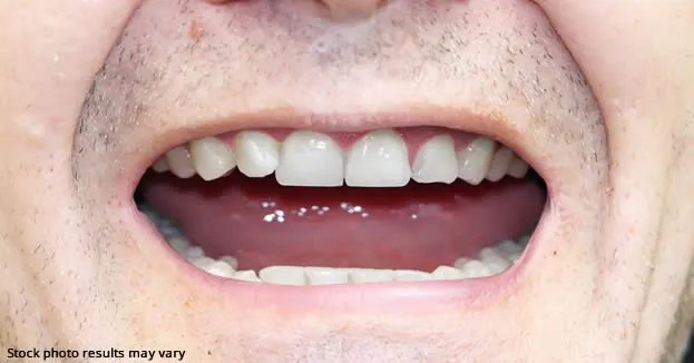 Keep Your Mouth Healthier by Choosing Invisalign Over Traditional Braces