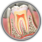 Causes of Post-Root Canal Therapy Pain