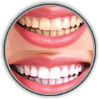 After Teeth Whitening: Do's and Don'ts