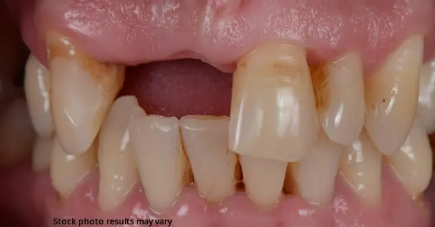 Types of Dental Crown and Bridge Materials Available