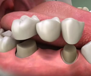 Restore Your Smile with Dental Crowns and Bridges
