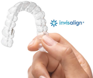 Invisalign Teen: Everything You Should Know