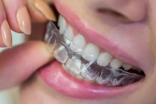 Invisalign versus Braces: Which is the Better Option for Straightening Teeth?