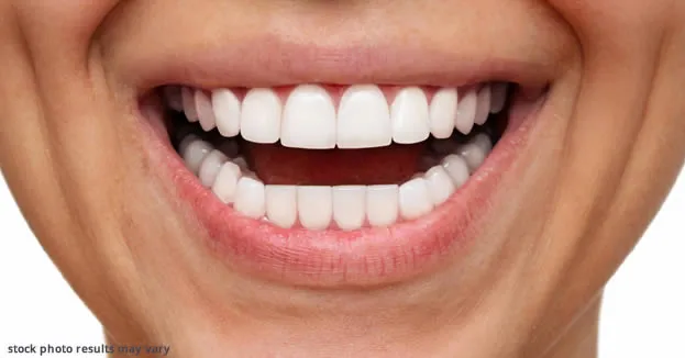 Types of "No-Prep" Veneers