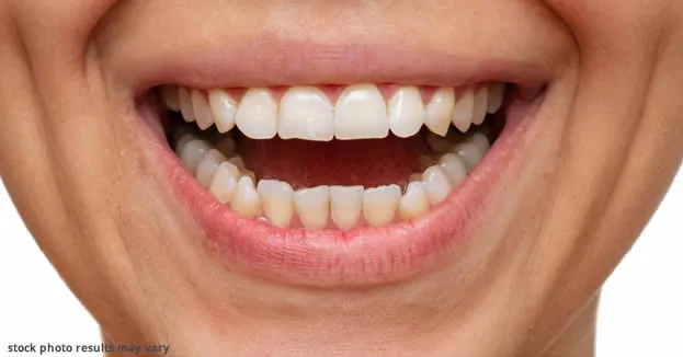 What You Should Know About Porcelain Veneers