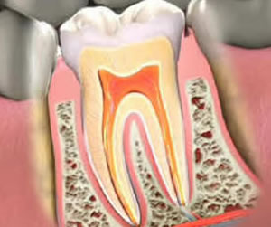 Endodontics or Root Canal Therapy