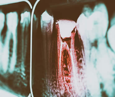 Speed Up Your Root Canal Recovery!
