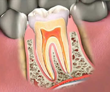Why Choose an Endodontist for Your Root Canal?