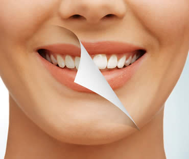 Types of Professional Teeth Whitening