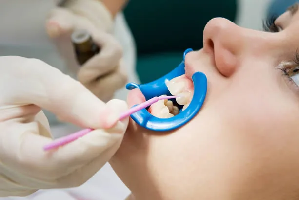 Dental sealants applied to teeth at William H. Smythe DMD