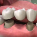 Understanding the Basics About Dental Crowns and Dental Bridges