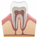 Factors that Affect Your Root Canal Recovery